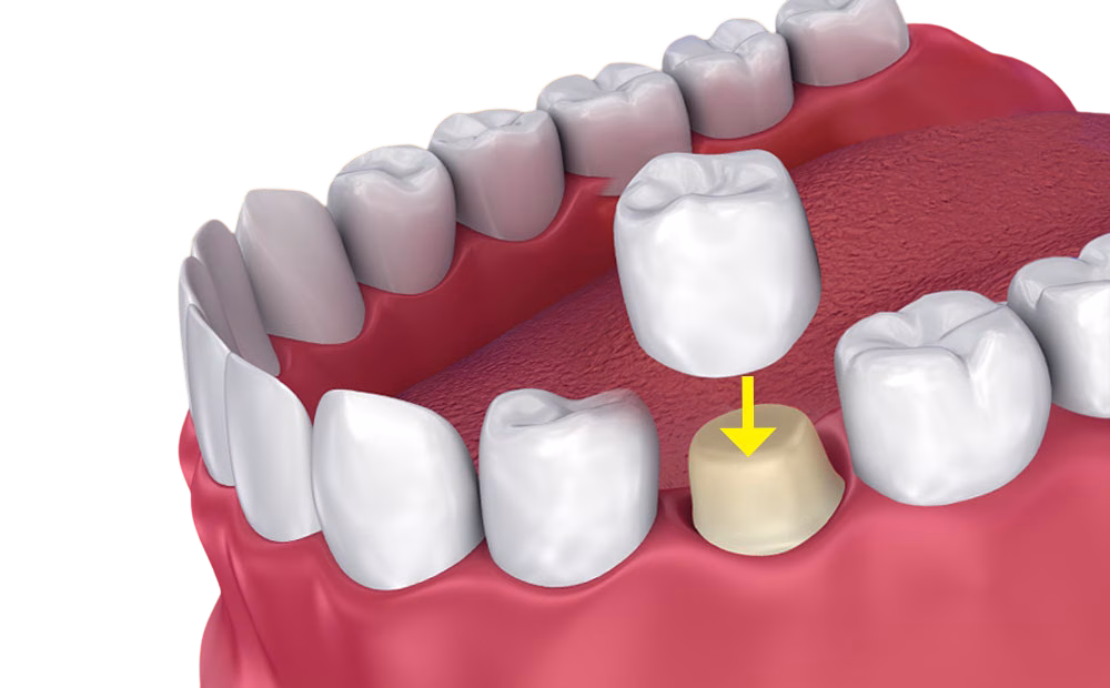 Coroane Dentare DipaDent Bucuresti